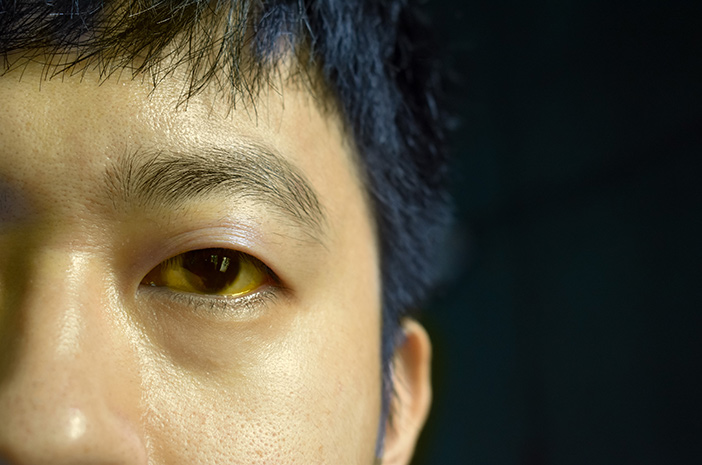 KULIT DAN MATA PUTIH MENJADI PUTIH KERANA BERLAKU PENYAKIT KUNING(JAUNDICE)